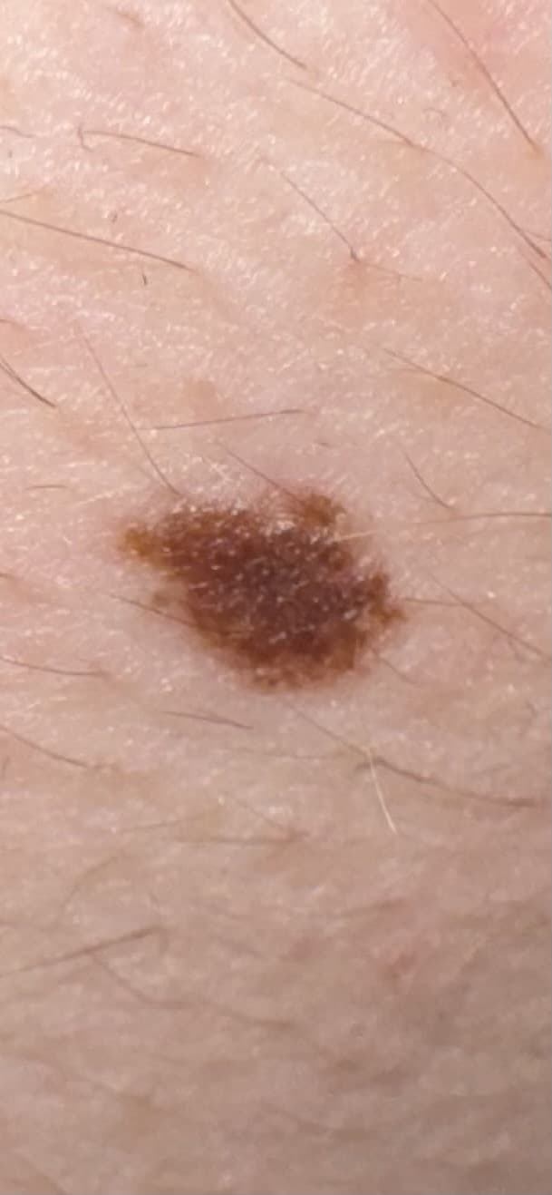 Raga mi sta venendo un ansia.Ho questo neo.Appena lo ha visto il medico mi ha prescritto una visita con urgenza.Ha tutti i segnali per essere pericolo
