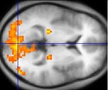 Qui si può chiaramente vedere il funzionamento dell' cervello di una persona depressa, la depressione è classificata come "disturbo mentale"