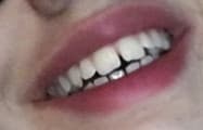 Ho il diastema, e allora?