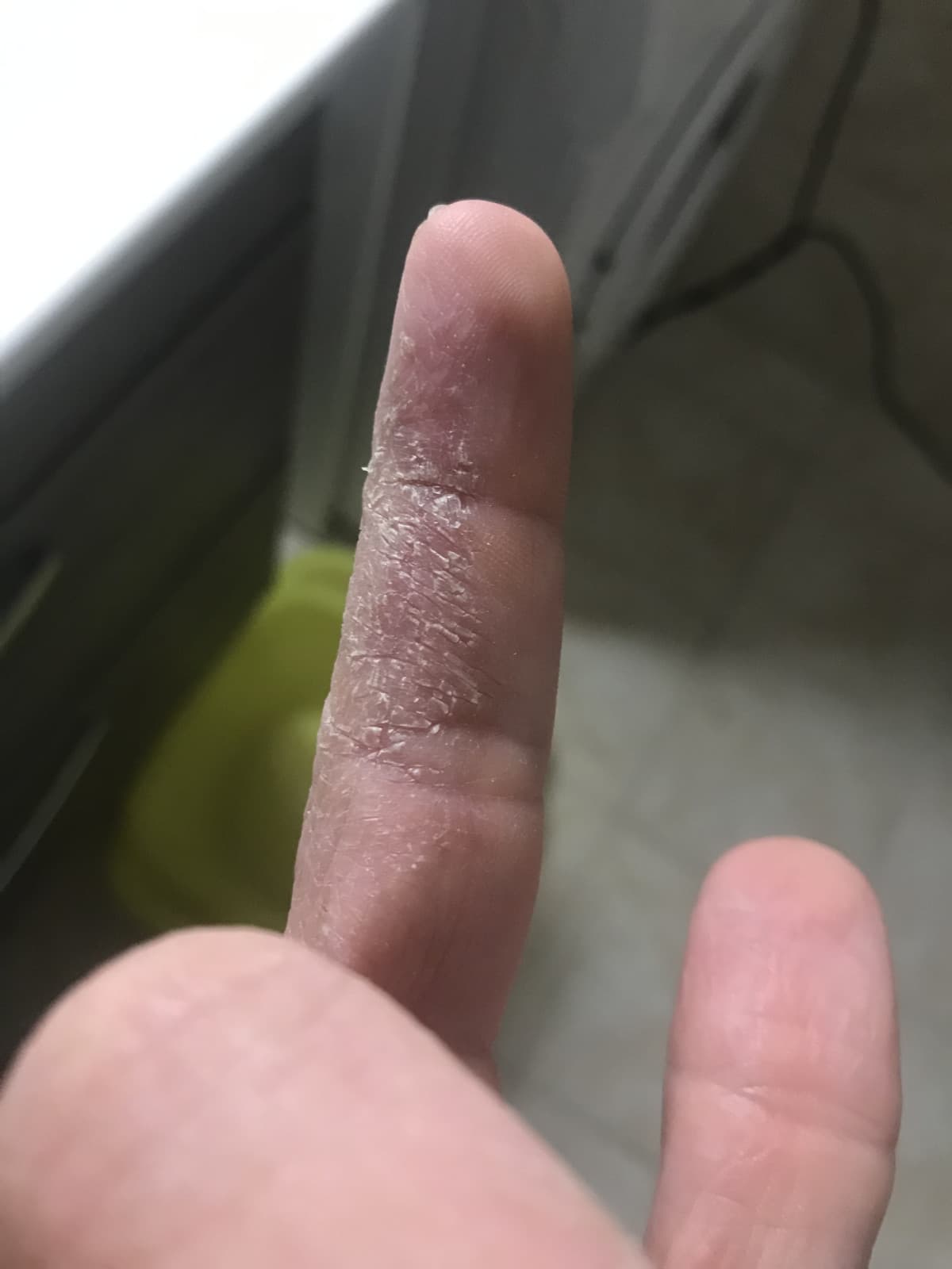 Ho tutte le dita in questo stato! Non riesco manco a chiuderle, ora ho fatto la doccia ma mi esce sangue, un altro po’ muoio dissanguato :,(