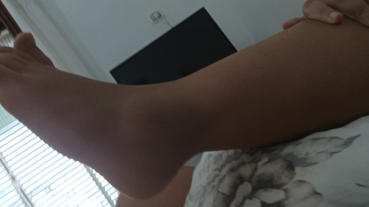 Che pezzo di livido