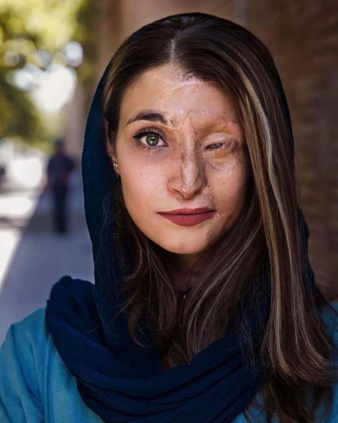 Lei è Marzieh Ebrahimi, donna iraniana attaccata con l'acido perché aveva scelto di non indossare l'hijab.